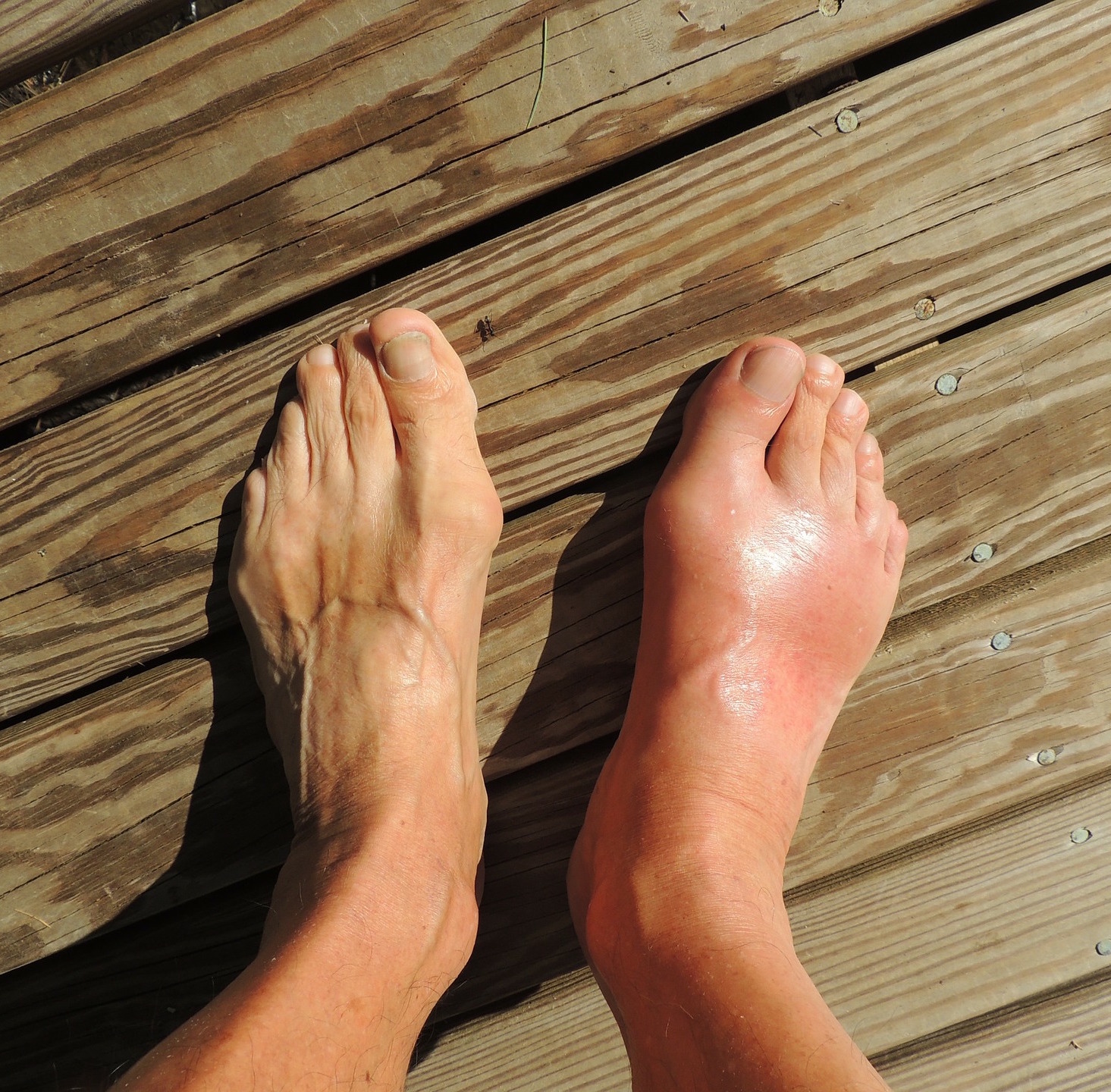pictures of gout in foot | Lifescript.com